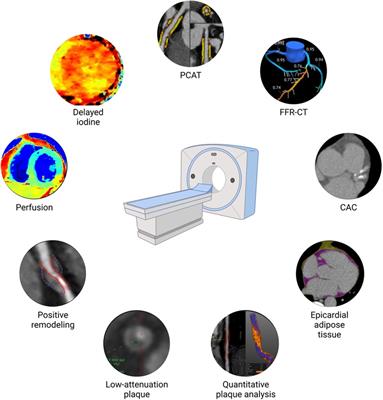 Editorial: Old habits die hard: from risk calculators and stenosis evaluation to phenotyping coronary atherosclerosis using cardiac CT